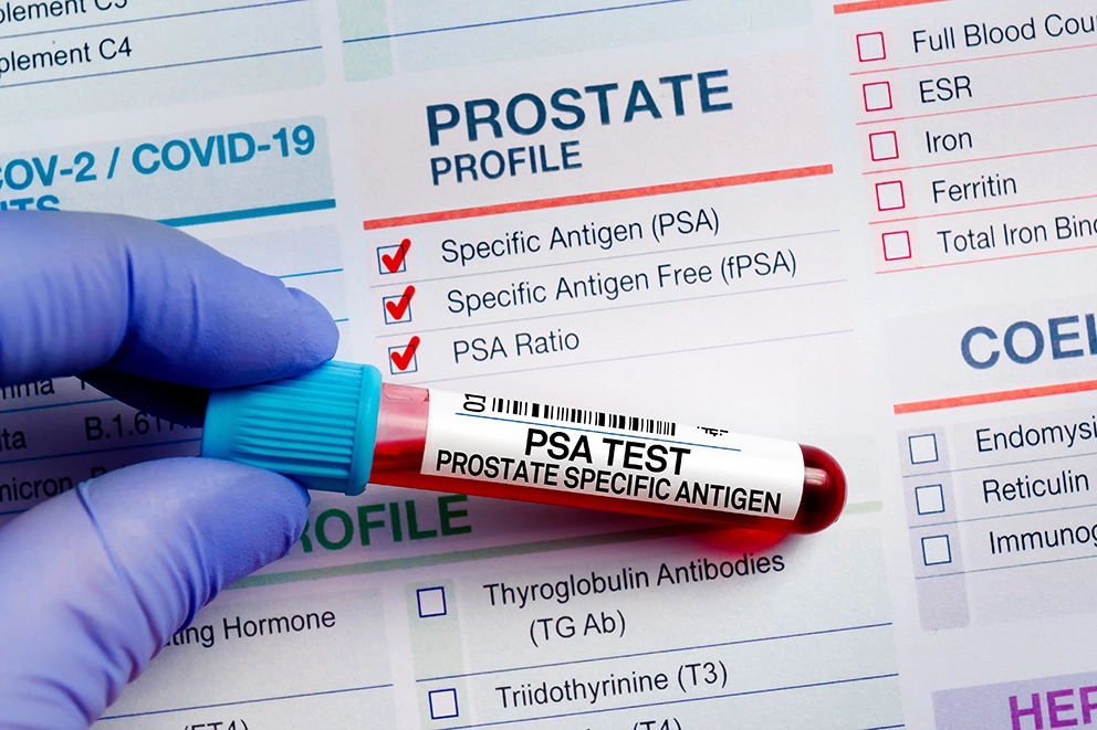 PSA testing